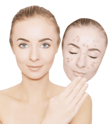 ماسک های ضد لک خانگی با ژل رویال