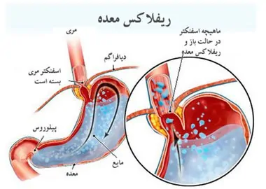 ژل رویال برای ریفلاکس معده