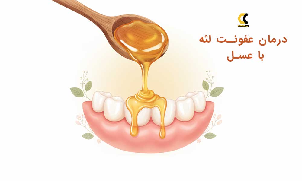 درمان عفونت لثه با عسل